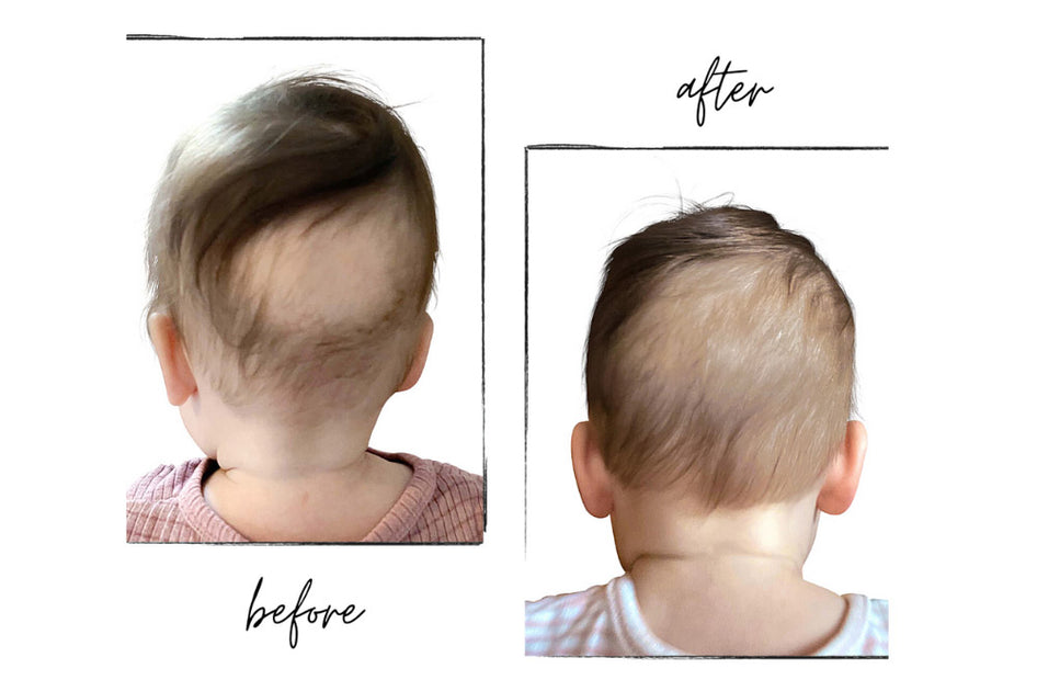 How to Get Rid of Baby Bald Spots Sleep Secrets Sleepy Silk