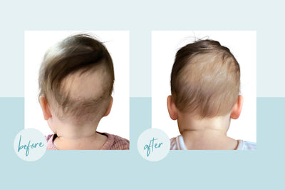 How Can I Help My Baby's Bald Spot?